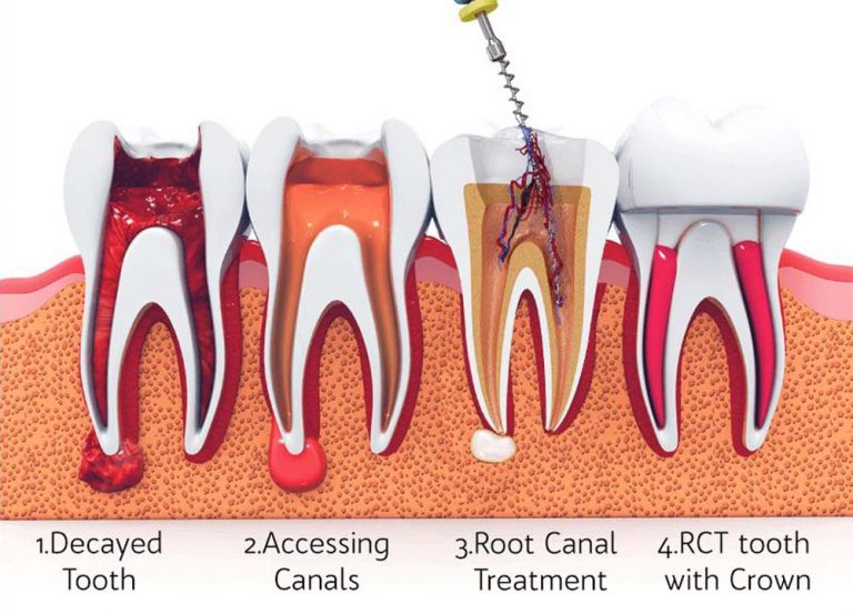 รักษารากฟัน พัทยา คลินิกทันตกรรมที่ดีที่สุด มีทันตแพทย์เฉพาะทางพร้อมดูแลคุณ