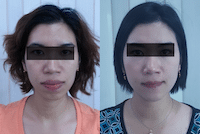 จัดฟันด้วยดาม่อน พัทยา ศรีราชา