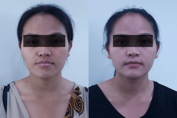 จัดฟันร่วมกับการผ่าตัด พัทยา ศรีราชา