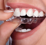 การฟอกฟันขาว เป็นการลบคราบจากการทานอาหารที่ติดแน่นอยู่บนผิวฟันออกไปได้ รวมทั้งยัง แก้ฟันเหลือง ได้อย่างมีประสิทธิภาพที่สุด