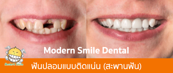 ฟันปลอมแบบติดแน่น แบบสะพานฟัน แก้ไขฟันหน้าหลอ 1 ซี่