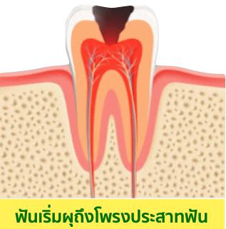 อุดฟัน ฟันผุแบบเป็นหลุมกินเข้าไปลึกมากขึ้น และทำลายจนมีการอักเสบลุกลามถึงโพรงประสาทฟัน 