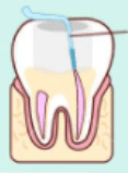 อุดคลองรากฟัน หลังจากกำจัดเชื้อในคลองรากฟันหมดแล้ว
