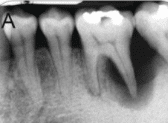 โรคเหงือก ติดเชื้อที่ปลายรากฟัน ต้องรักษารากฟัน ร่วมกับการรักษาโรคเหงือก